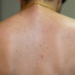 Back Acne Scars and Marks