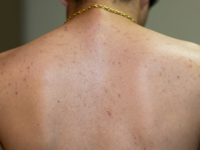 Back Acne Scars and Marks