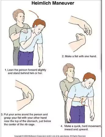 The Heimlich Maneuver